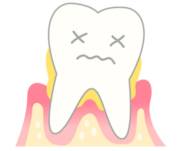 歯周病・予備軍